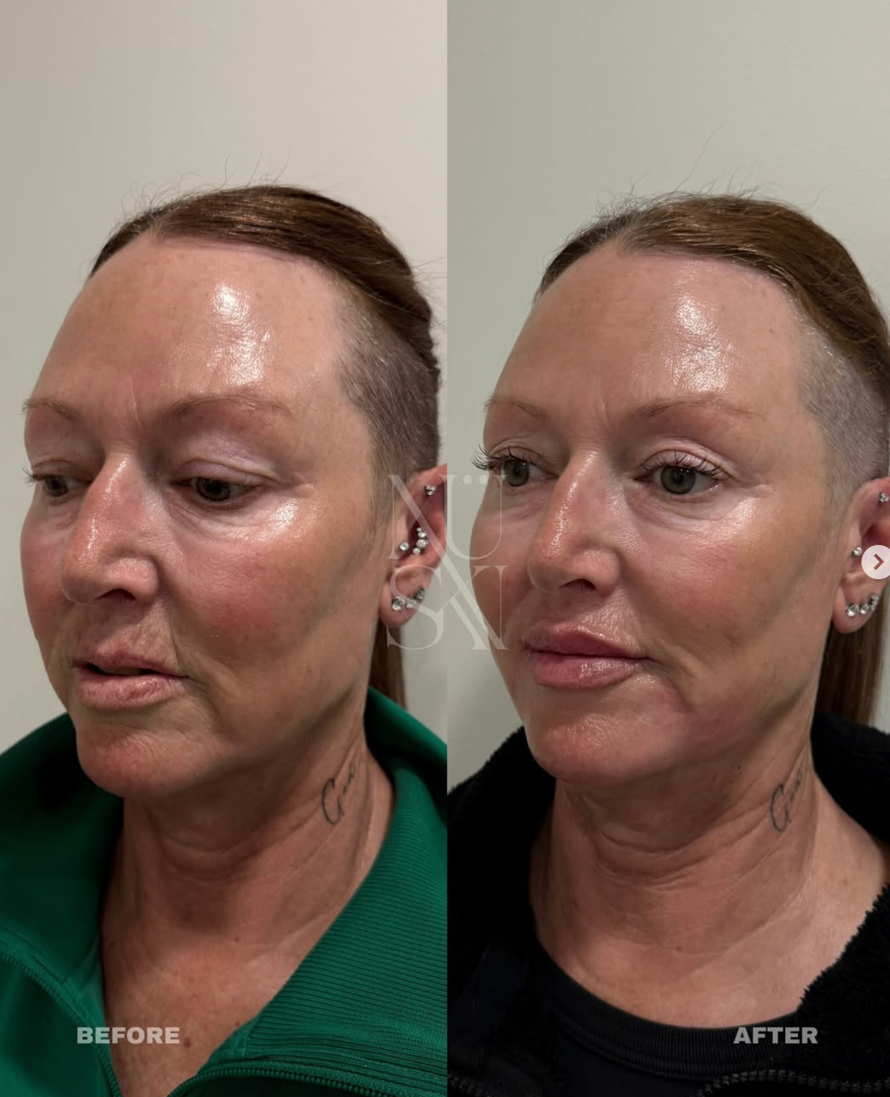 Before and after — NÜSKN client
