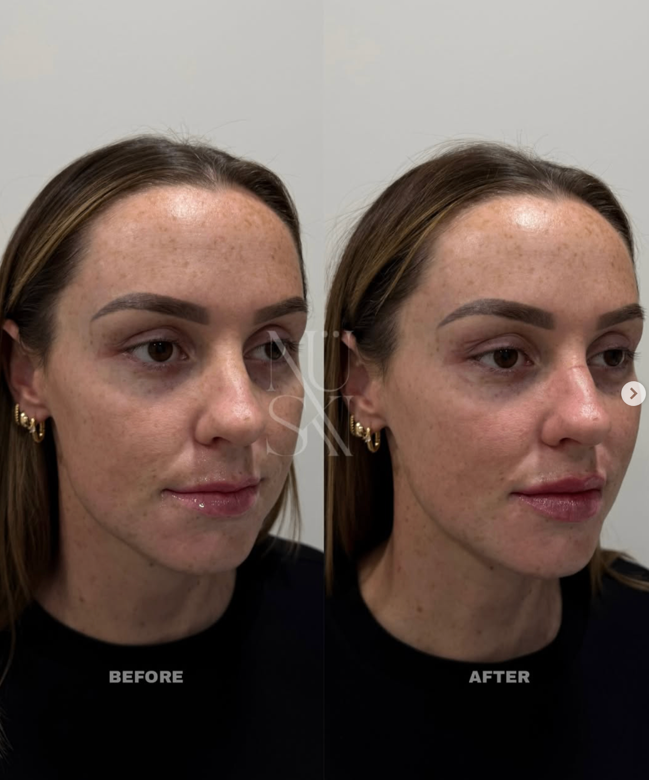 Before and after — NÜSKN client