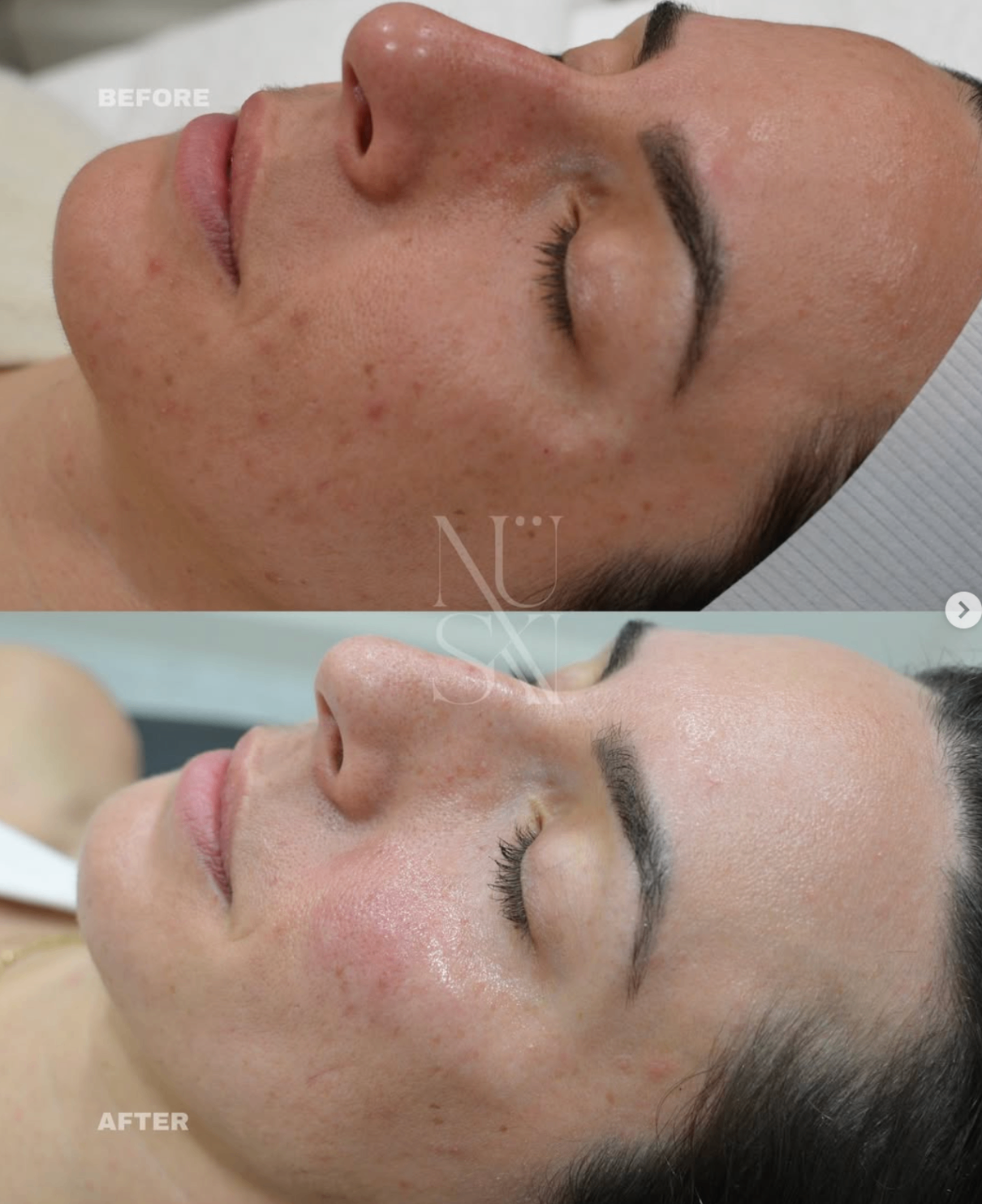 Before and after — NÜSKN client