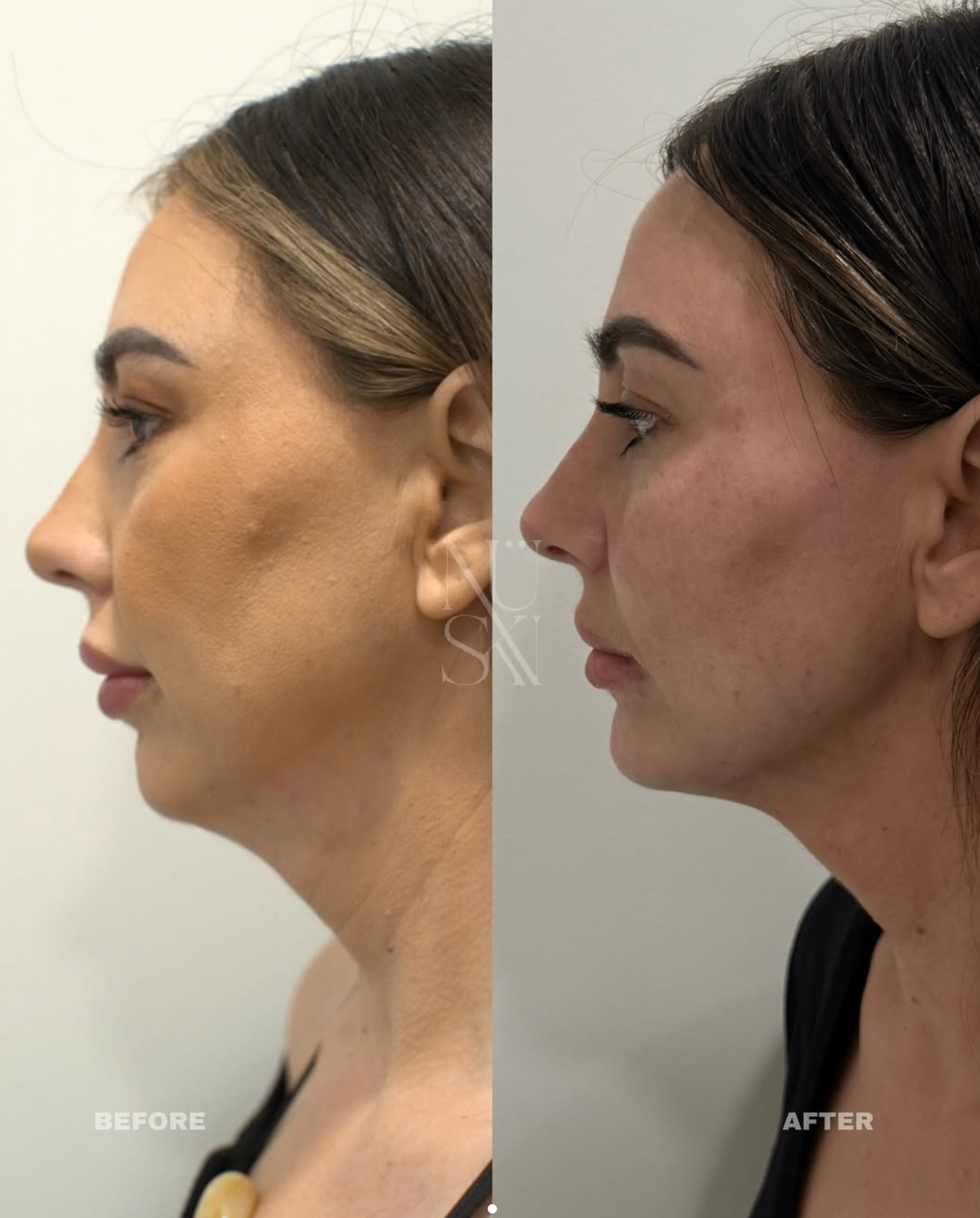 Before and after — NÜSKN client