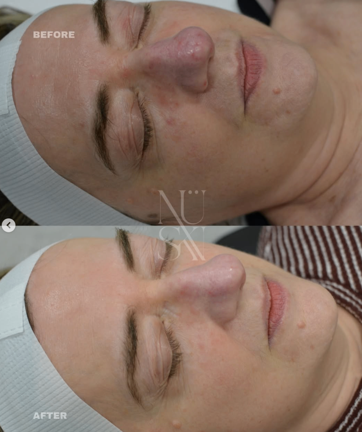 Before and after — NÜSKN client